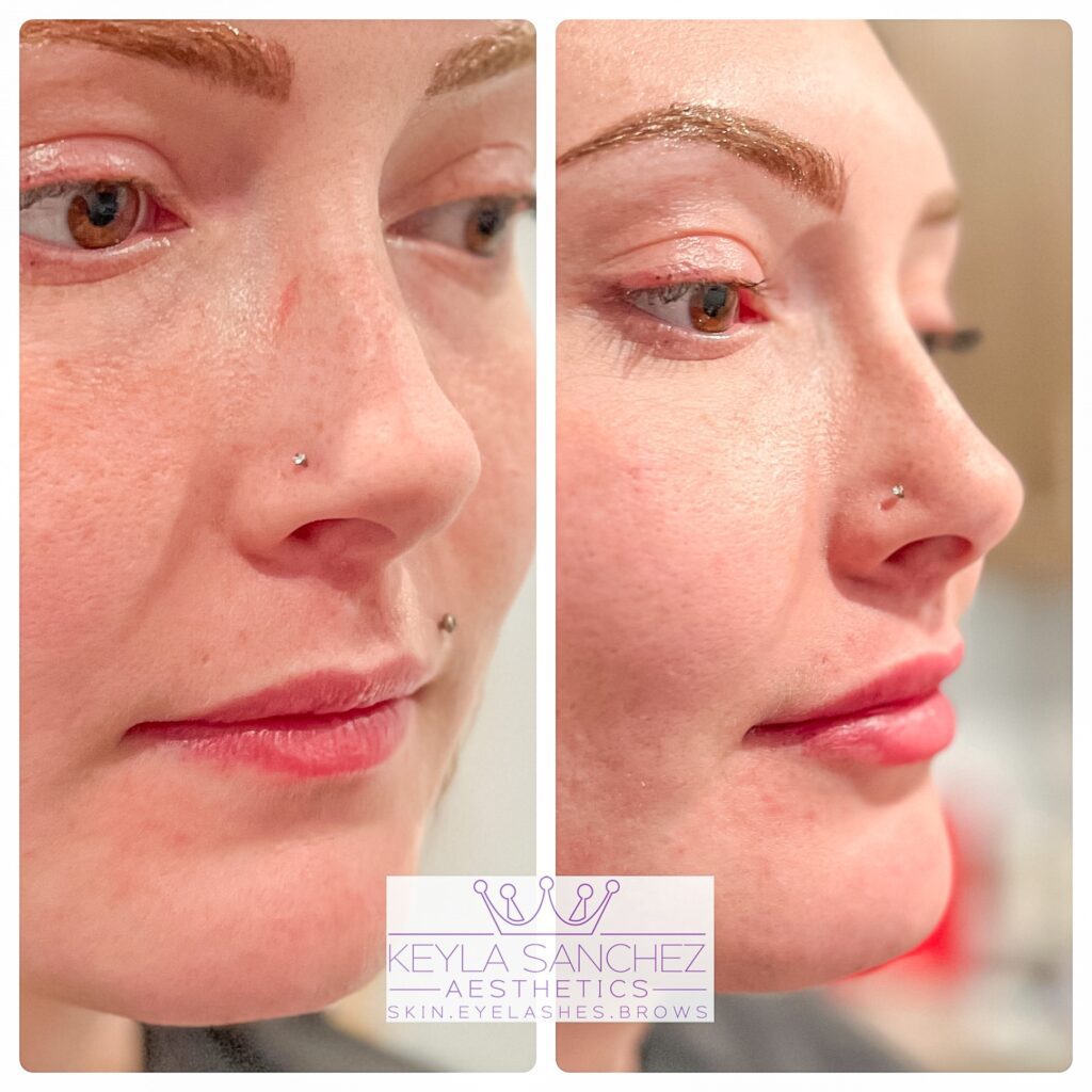 Before and after lip filler Before and after lip filler.