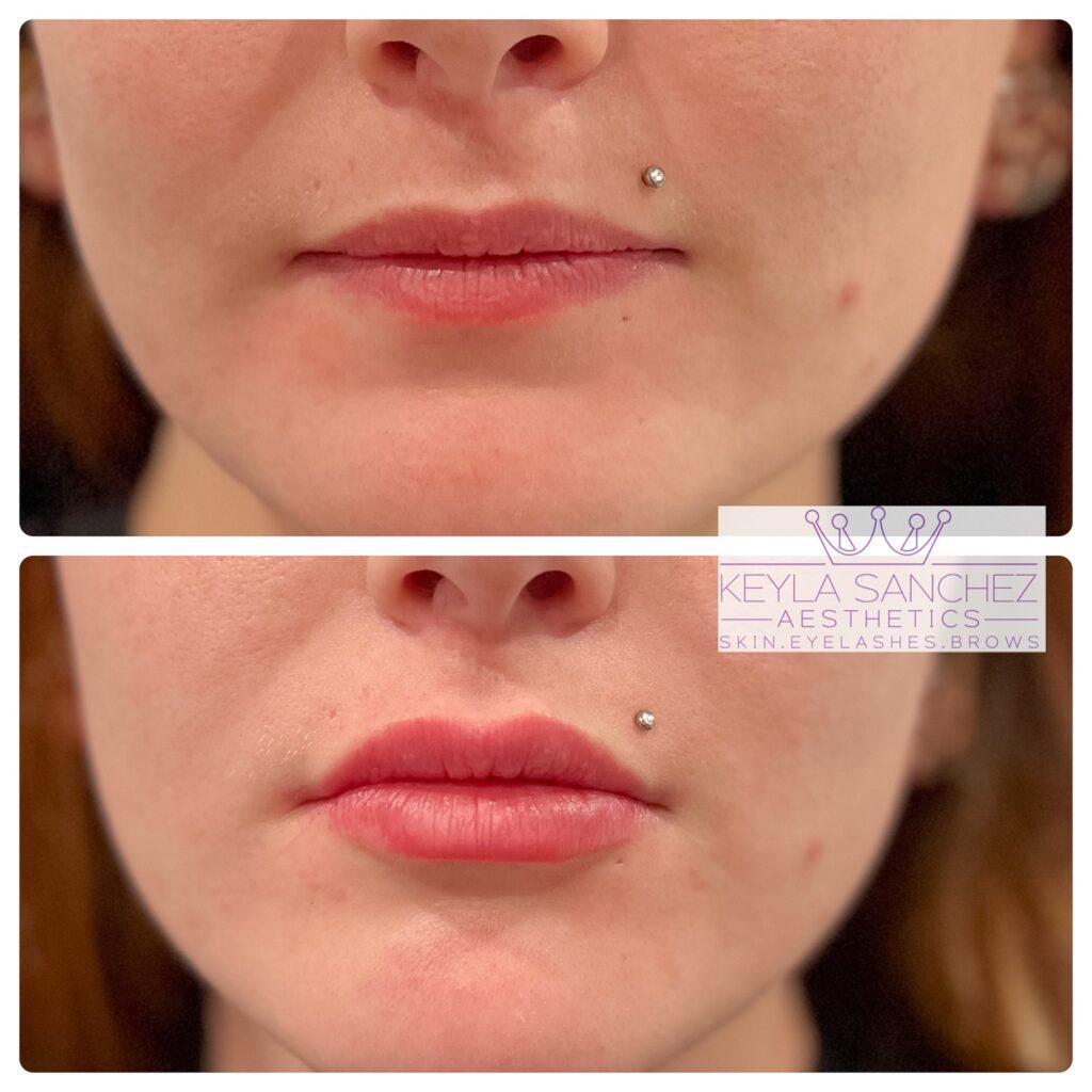 After lip filler After lip filler.