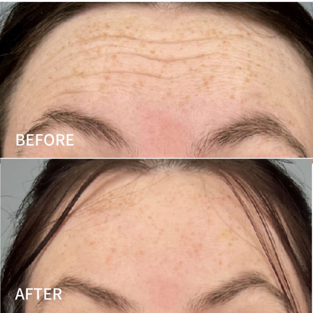 Forehead lines before Botox treatment Forehead lines before Botox treatment.