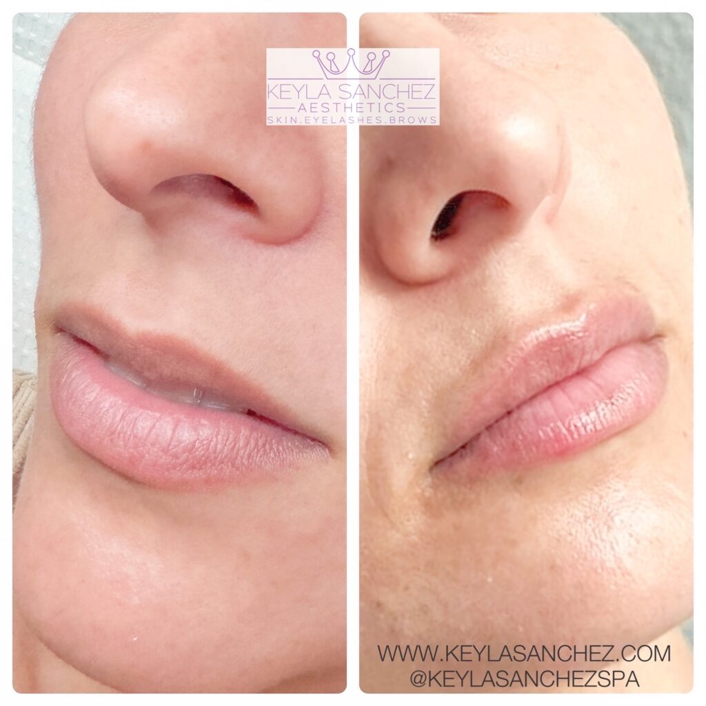 Before and after lip filler Before and after lip filler.
