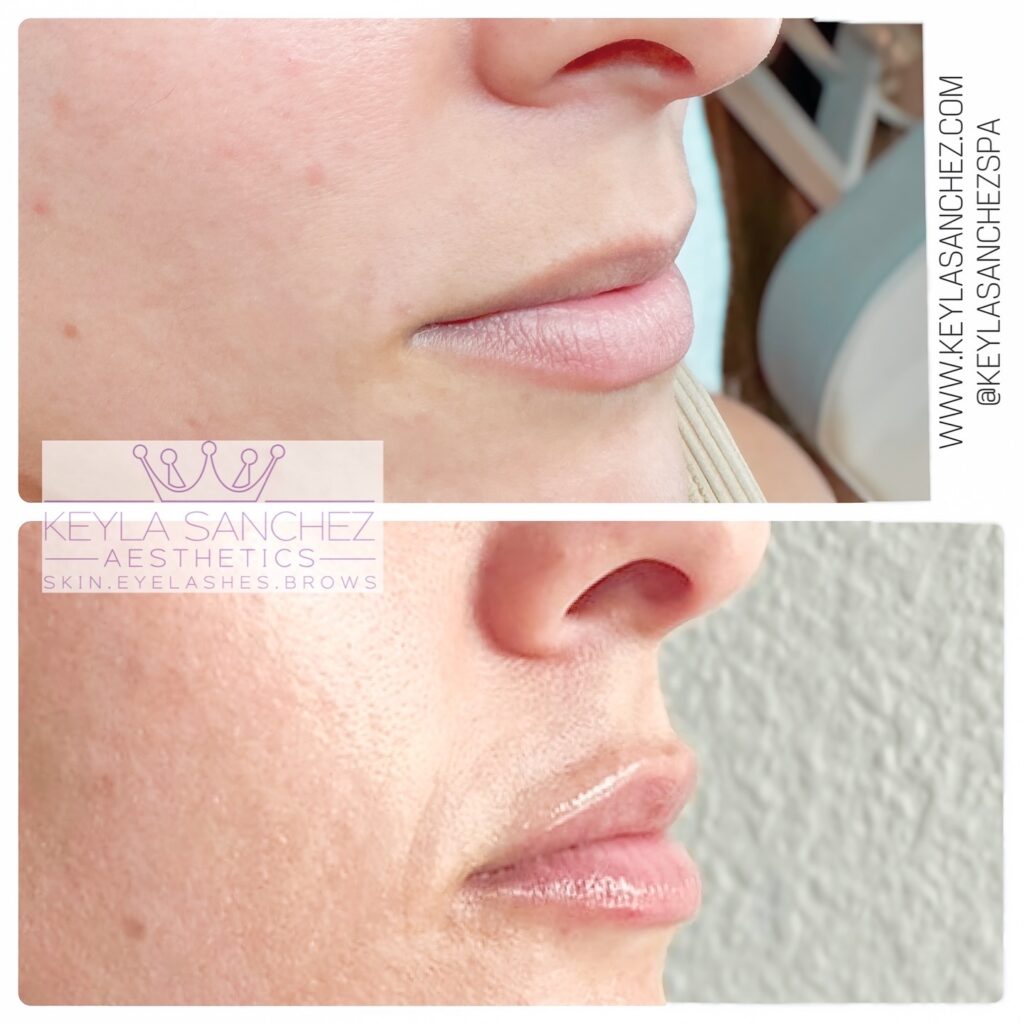 Before and after lip filler, side profile Before and after lip filler, side profile.
