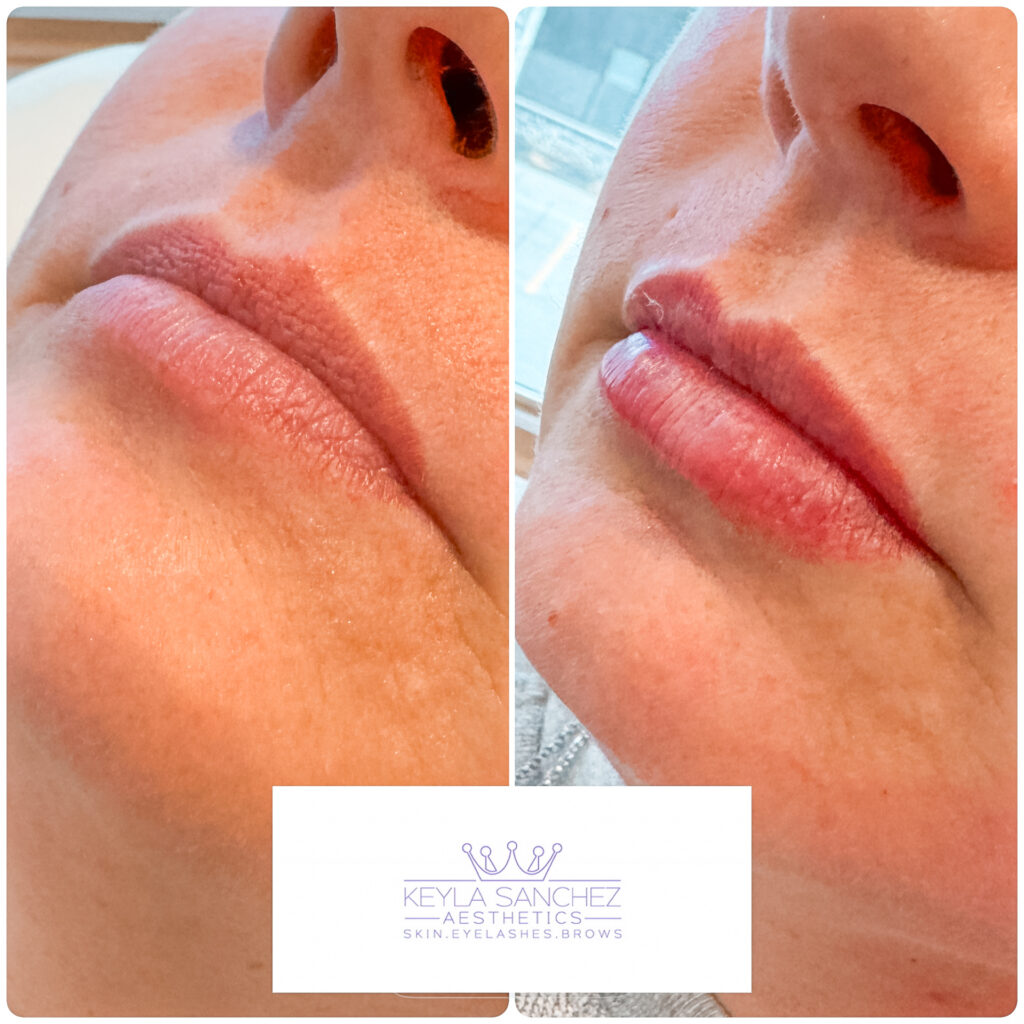 Before and after lip filler Before and after lip filler.