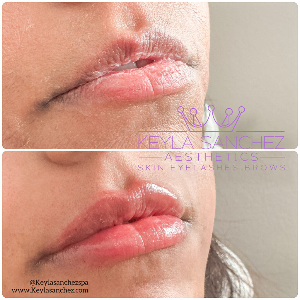 Before and after lip filler Before and after lip filler.