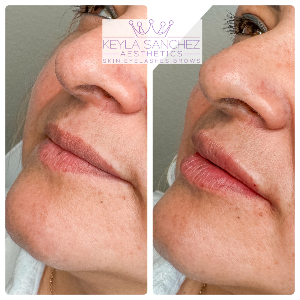 Before and after lip filler Before and after lip filler.