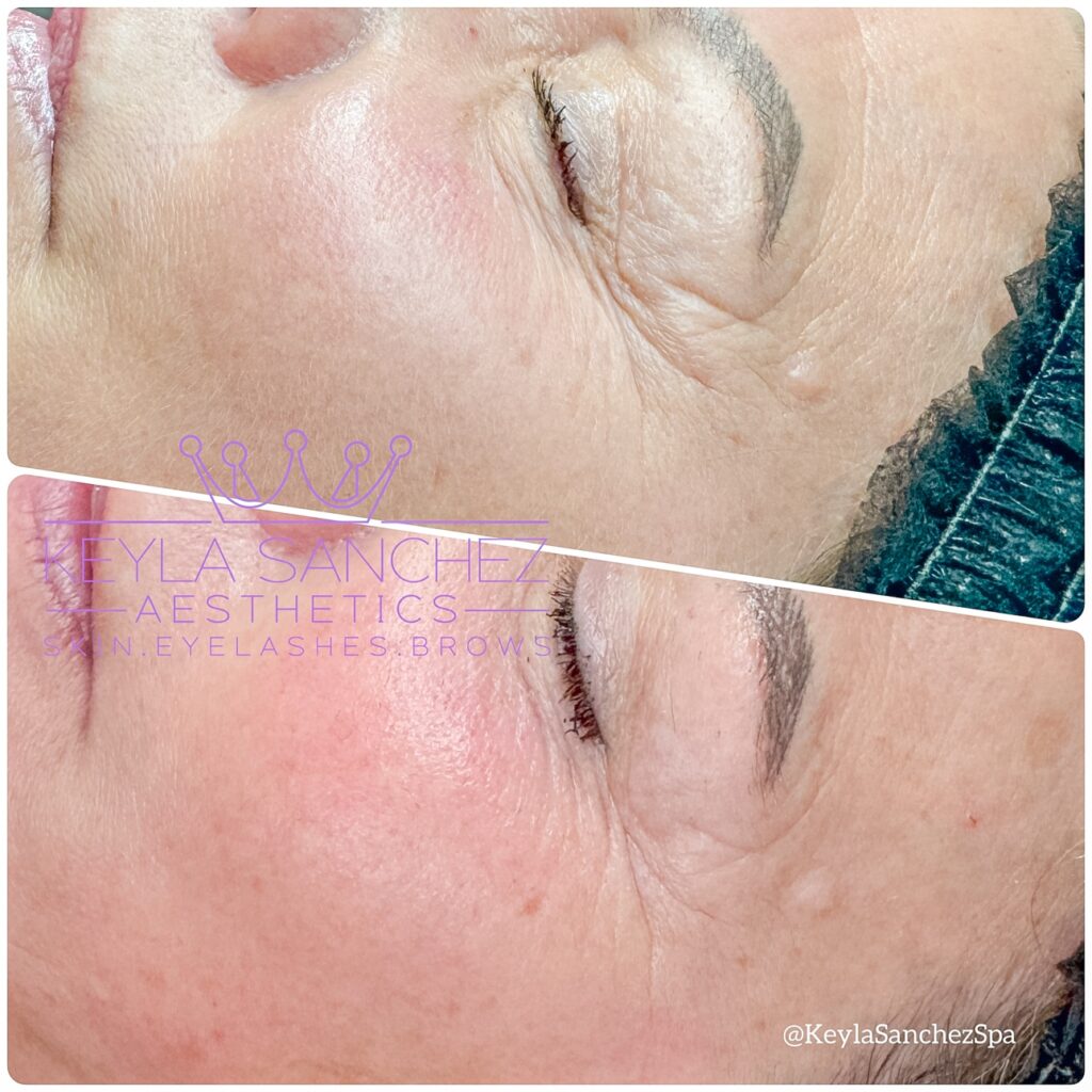 After one session of microneedling After one session of microneedling.