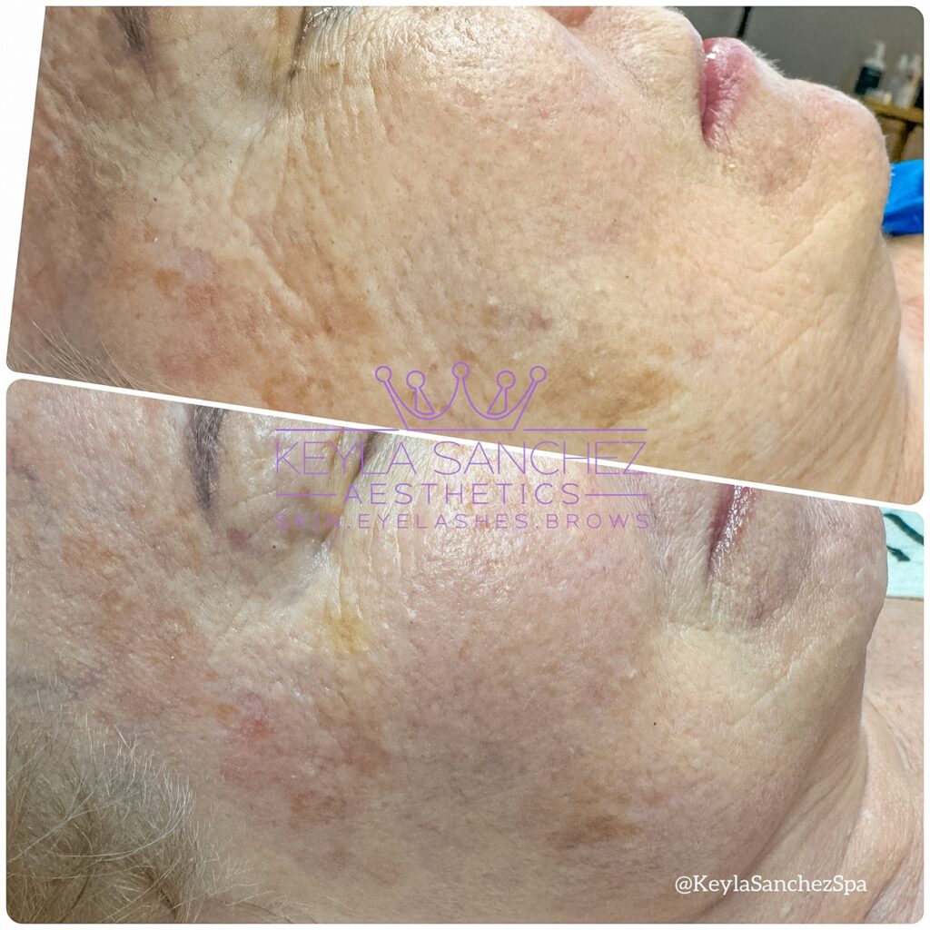 Before and after skin treatment on mature skin Before and after skin treatment on mature skin.