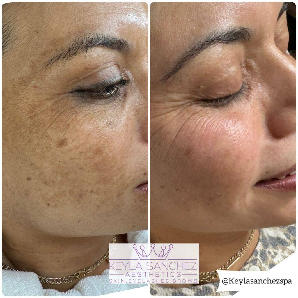 Personalized treatments for hyperpigmentation / melasma Personalized treatments for hyperpigmentation / melasma