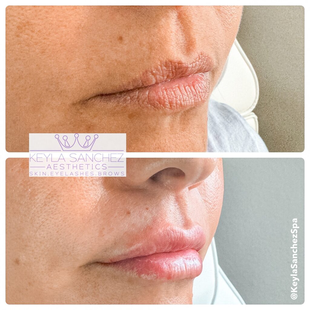 Before and after lip filler Before and after lip filler.