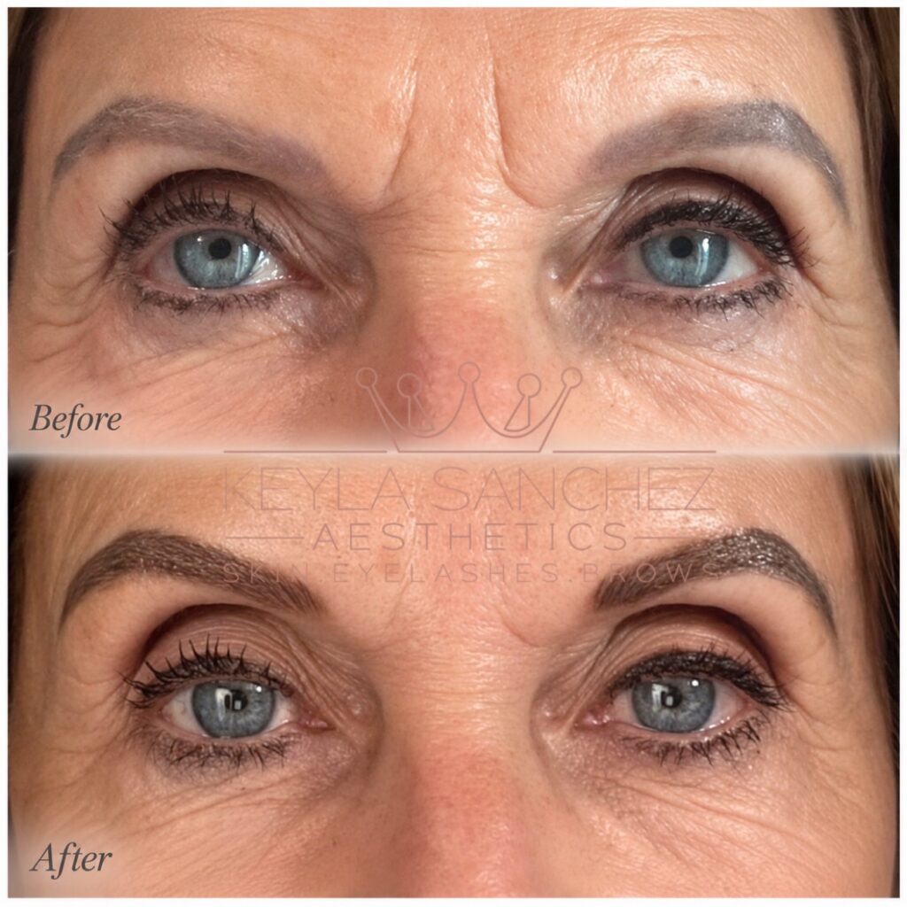 Before and after Botox treatment Before and after Botox treatment